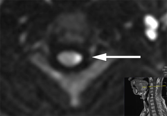 Figure 2 Axial diffusion-weighted MR image (B1000) at level C2/3 showing area with a high signal on the left of the medulla,&hellip;