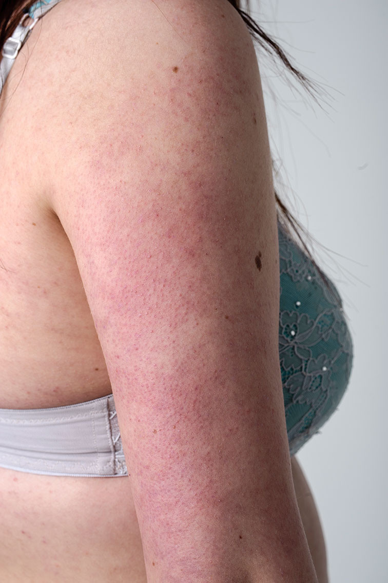 Figure 1 Keratosis pilaris on the upper arm.
