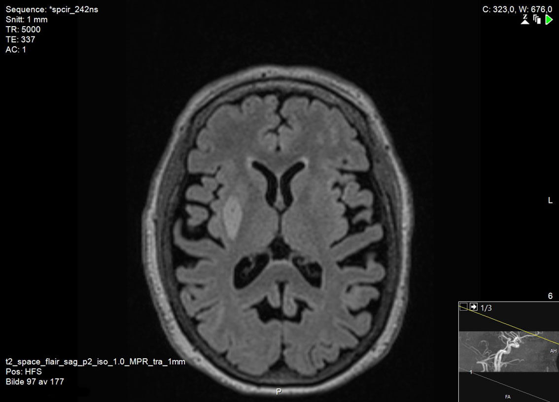 Figur 1 MR av hjernen ved vaskul&aelig;r parkinsonisme, subtype 1. T2-FLAIR-sekvens viser h&oslash;ysignalforandringer i h&oslash;yre putamen,&hellip;