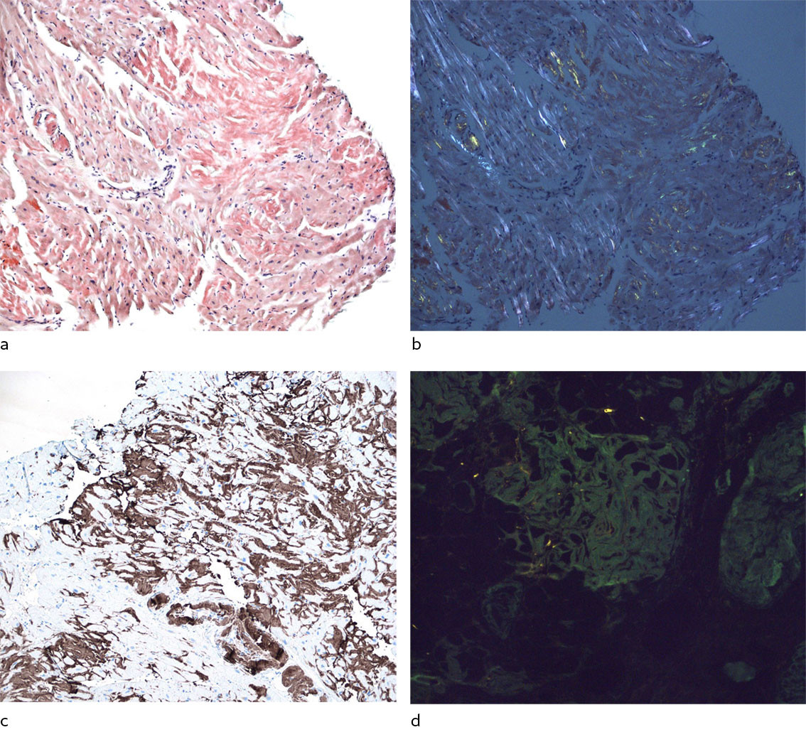 Figure 3 Endomyocardial biopsies. a) Congo red, the dark red areas are suggestive of amyloid deposits. b) Staining with&hellip;