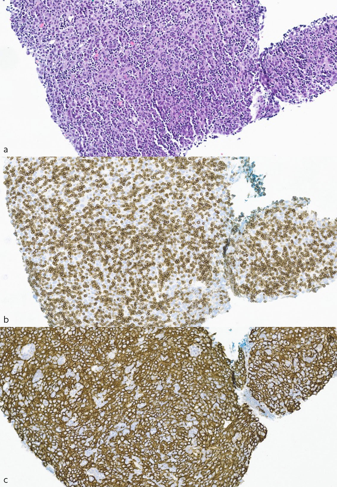 Figure 2 Section from the CT-guided biopsy of the pleural metastasis, approx. x400 magnification. a) Haematoxylin-eosin&hellip;