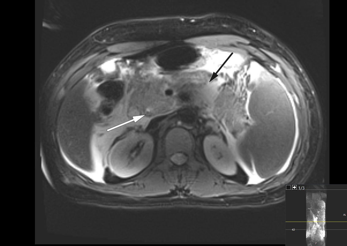 Figur 1 Magnetisk resonanskolangiopankreatografi (MRCP), transversalplan, tatt innleggelsesdag, viser et konkrement i ductus&hellip;