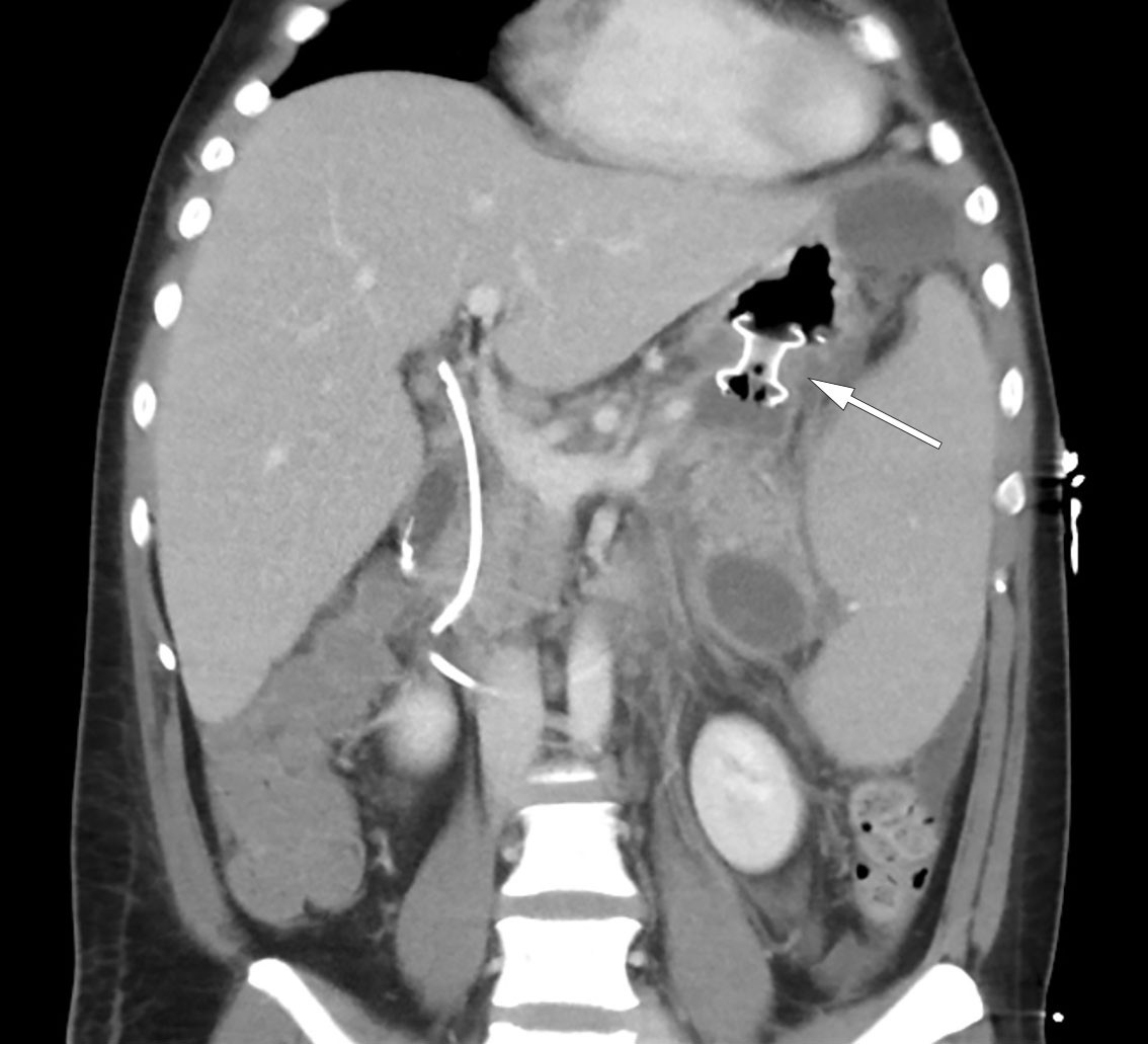 Figur 3 CT abdomen viser lumen-apposing metal stent (LAMS) av typen Hot AXIOS (pil), velfungerende drenasje og avtakende&hellip;