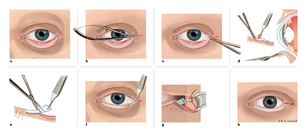 Figur 2 Lateral tarsal strip-prosedyre. Etter en kantotomi (b) og kantolyse (c) isoleres en liten lateral bit av nedre&hellip;