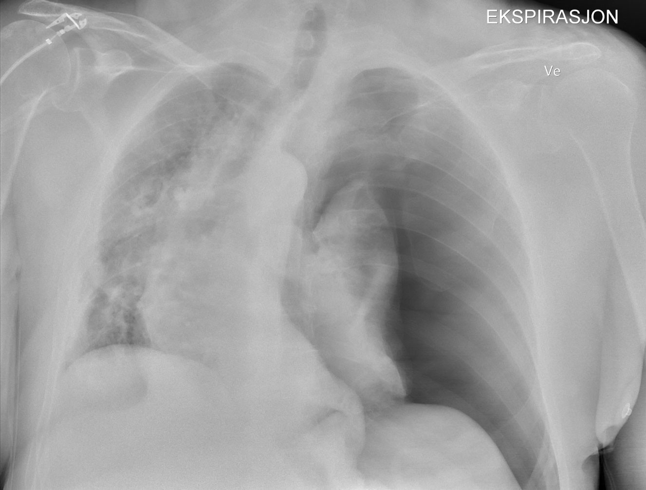 Figure 1 The x-ray shows left-sided tension pneumothorax with displacement of the mediastinum, trachea and heart to the&hellip;