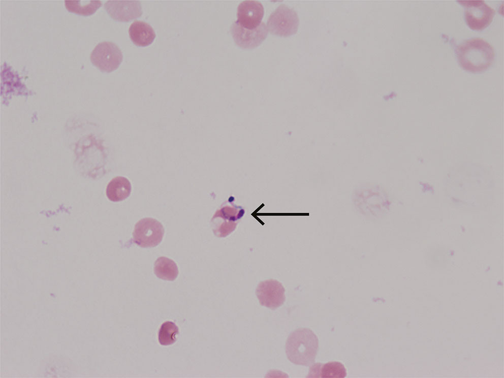 Figure 1 Giemsa-stained smear of cerebrospinal fluid from a patient with Chagas encephalitis shows Trypanosoma cruzi&hellip;