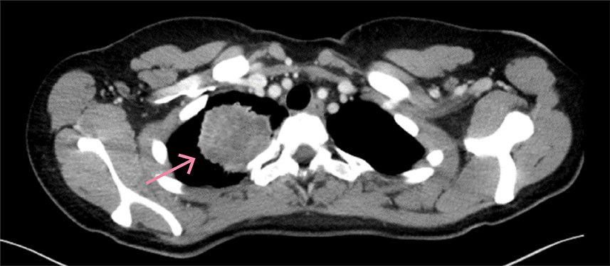 Figure 2 CT thorax. Tumour in the right upper lobe.