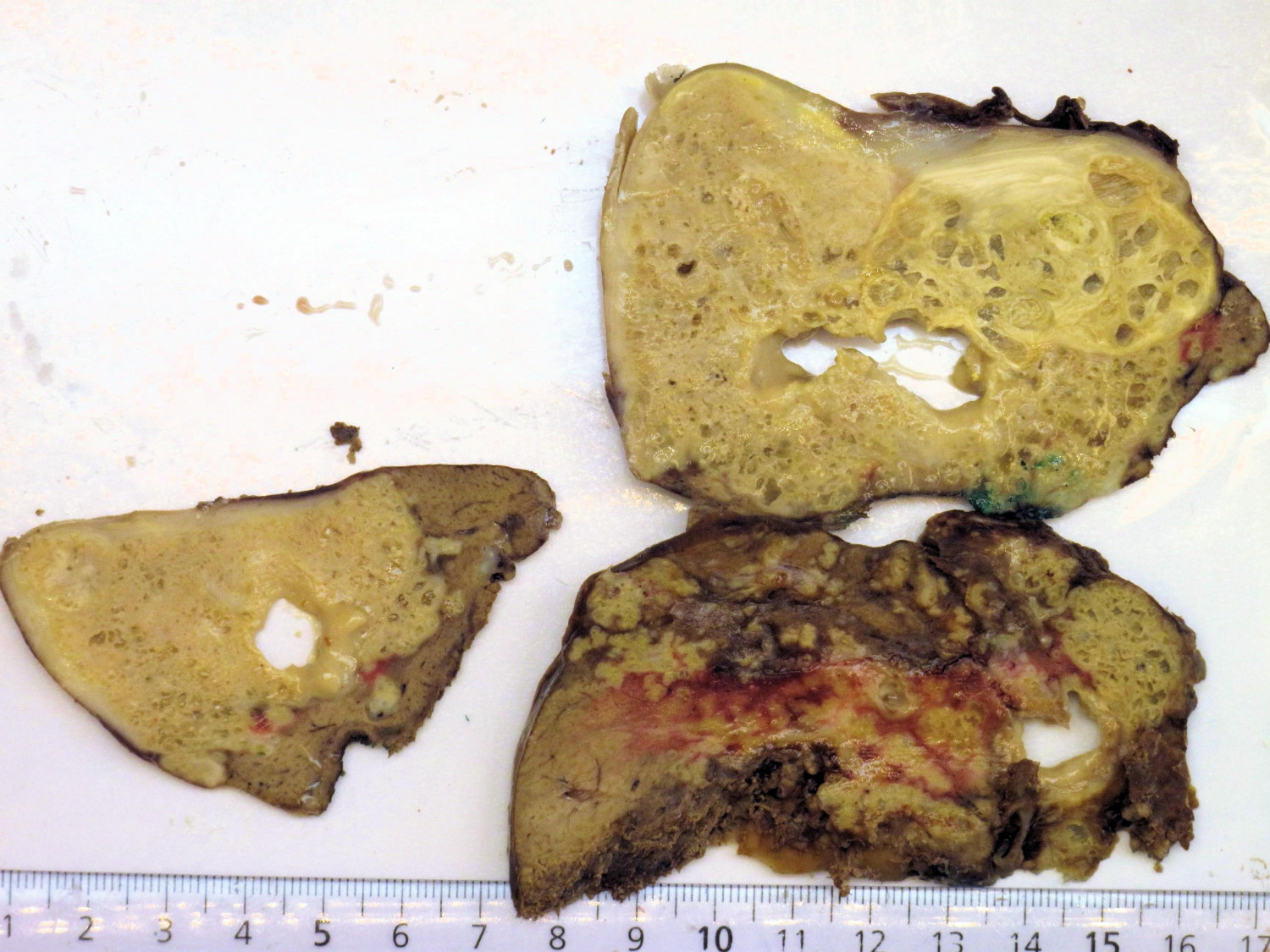 Figur 2 Operasjonspreparat viser multicystisk tumor i leversegment 6 og 7 (pasient 1).