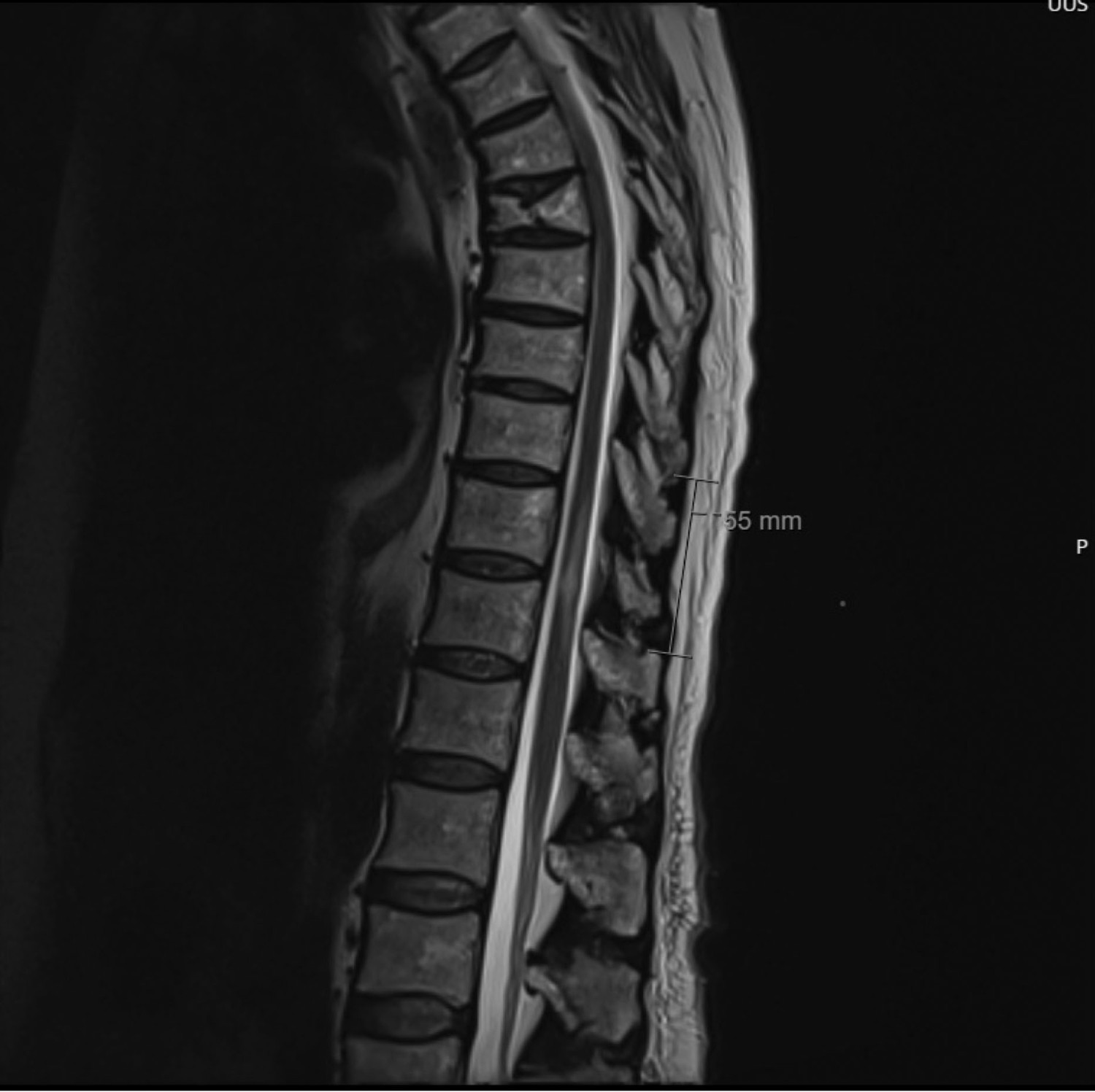 Figure 1 T2-weighted MRI image. T2 high-signal changes in the spinal cord at the Th11&ndash;Th12 levels can be observed. The&hellip;