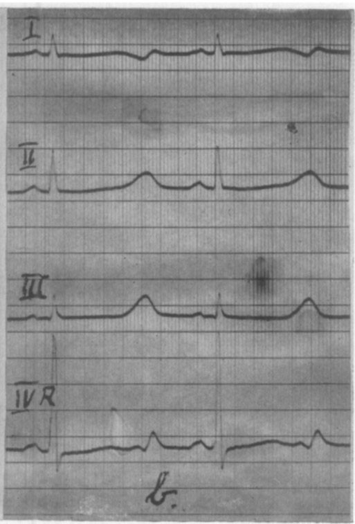 Figure 4 Facsimile from the article in the American Heart Journal in 1957 (1). The T wave (above the 'b' in the image) is&hellip;