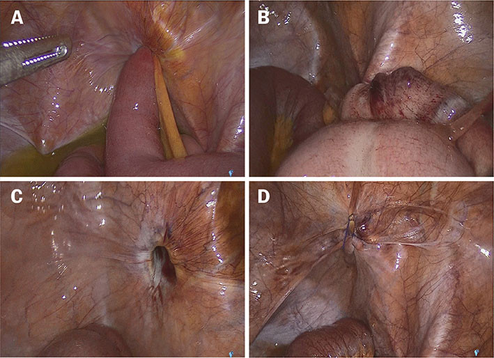 Figures 2a&ndash;d Perioperative images of the abdominal cavity showing (a) an incarcerated small bowel loop in the obturator&hellip;