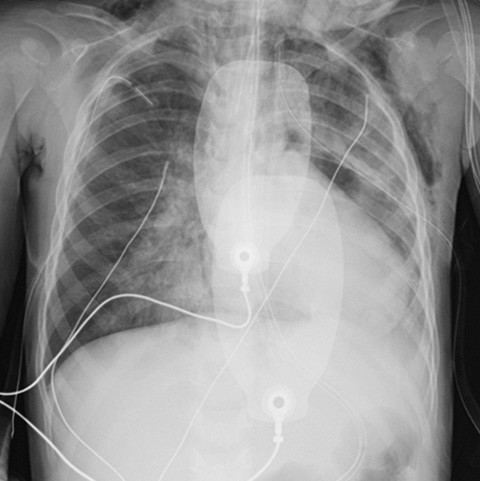 Figure 2 X-ray taken after intubation and chest drains on both sides. There was no pneumothorax, but increased opacity&hellip;