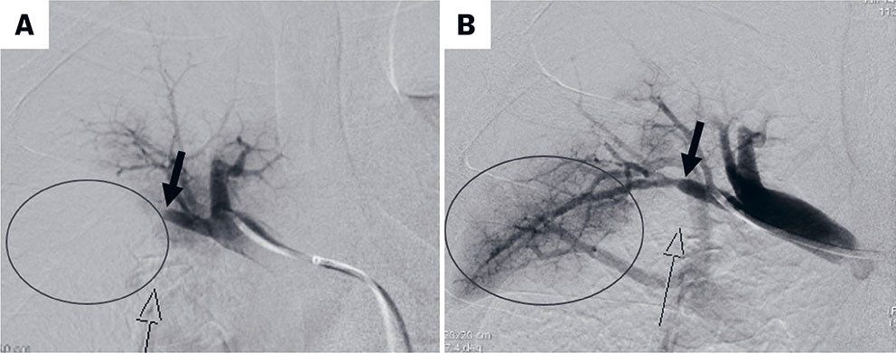 Figur 3 Angiografi f&oslash;r (A) og etter (B) pulmonal ballongarterioplastikk av okkludert segmentarterie til h&oslash;yre overlapp &hellip;