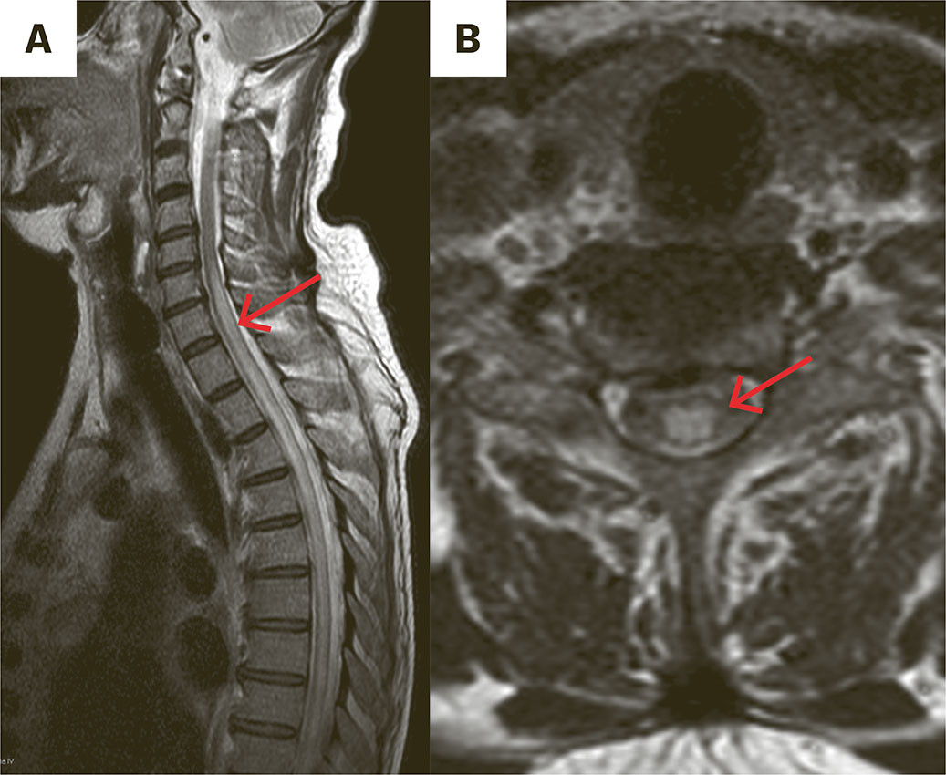 Figur 1 Sagittal (a) og aksial (b) T2-vektet MR totalkolumna med kontrast og fettsuppresjon (Dixon) dag 13 viste &oslash;kt signal&hellip;