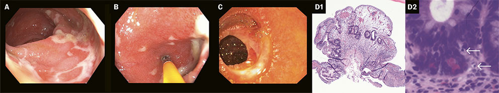 Figur 3 a) viser fibrinbelagte lesjoner i kolon; b) viser inflammasjon i terminale ileum; c) viser flekkvis erytem og plumpe&hellip;