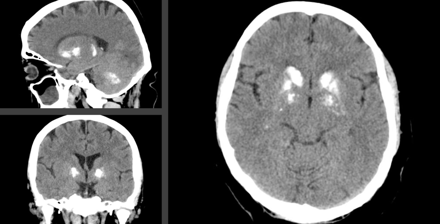 Figure 1 Selected slices from 3D computed tomography (CT) of the head and brain of a person diagnosed with Fahr's disease&hellip;