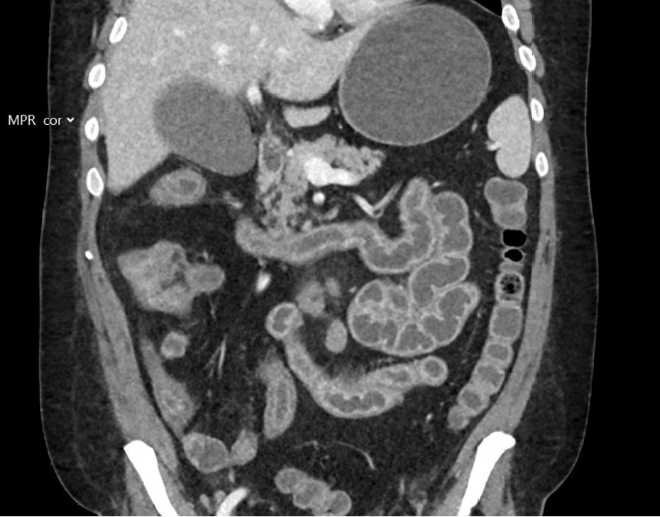 Figure 2 CT of the abdomen/pelvis with intravenous contrast shows inflammation of the small intestine.