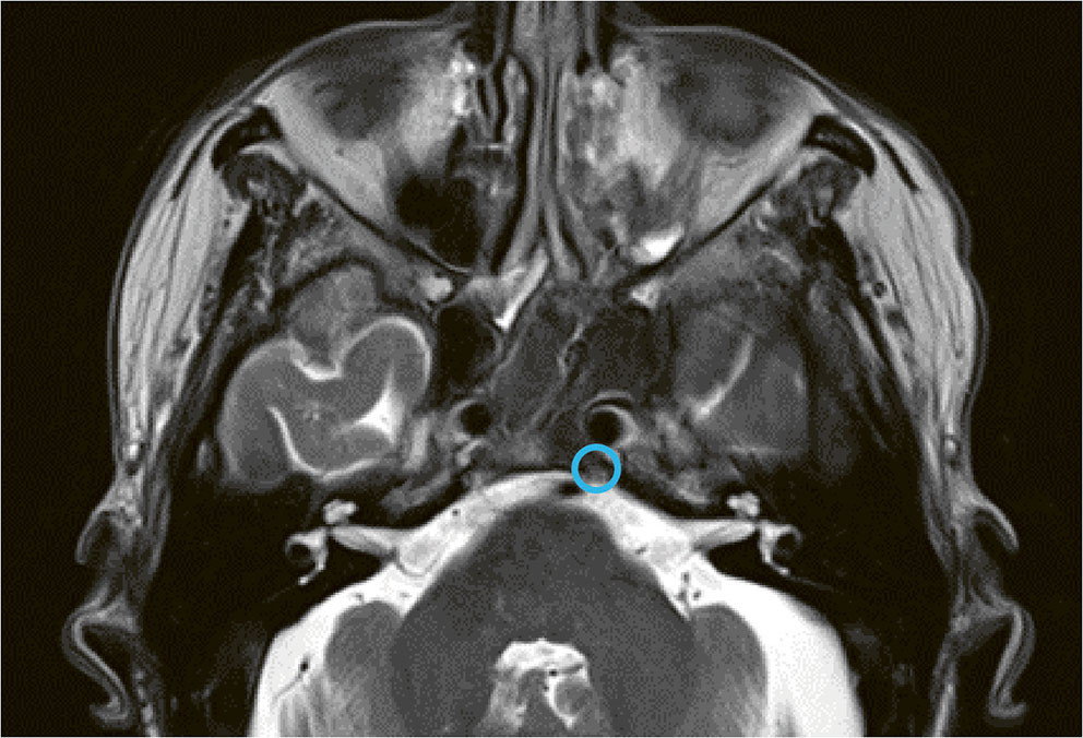 Figure 2 Axial T2-weighted MRI of the head showed no cerebral or intracranial pathology but demonstrated low signal&hellip;