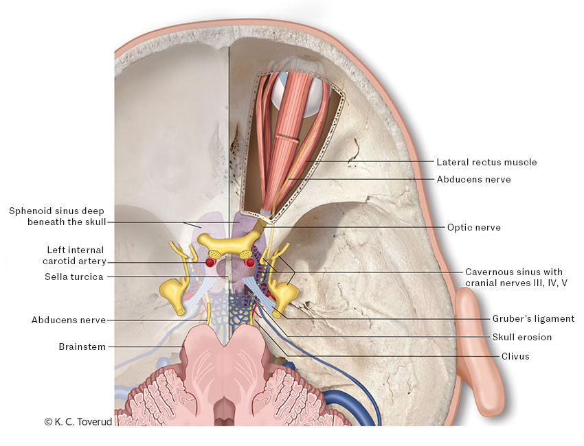 Figure 4 Anatomical relationships of the abducens nerve. On the left side of the illustration, the skull base is shown&hellip;