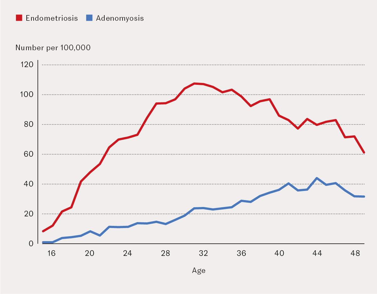 Figure 4 Age at first registration of endometriosis and adenomyosis in the specialist health service, by age group, in the&hellip;