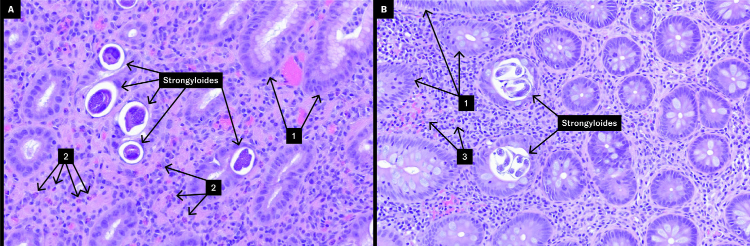 Figur 1 Biopsier (HES-farget) fra (A) ventrikkel- og (B) tykktarmslimhinne viste krypter med parasitter (Strongyloides) og&hellip;