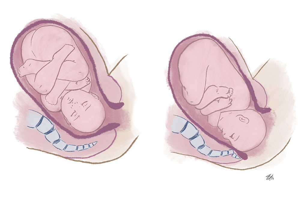 Figure 2 The illustration shows how the child's head can dislocate the lower coccygeal vertebrae during birth. Illustration:&hellip;