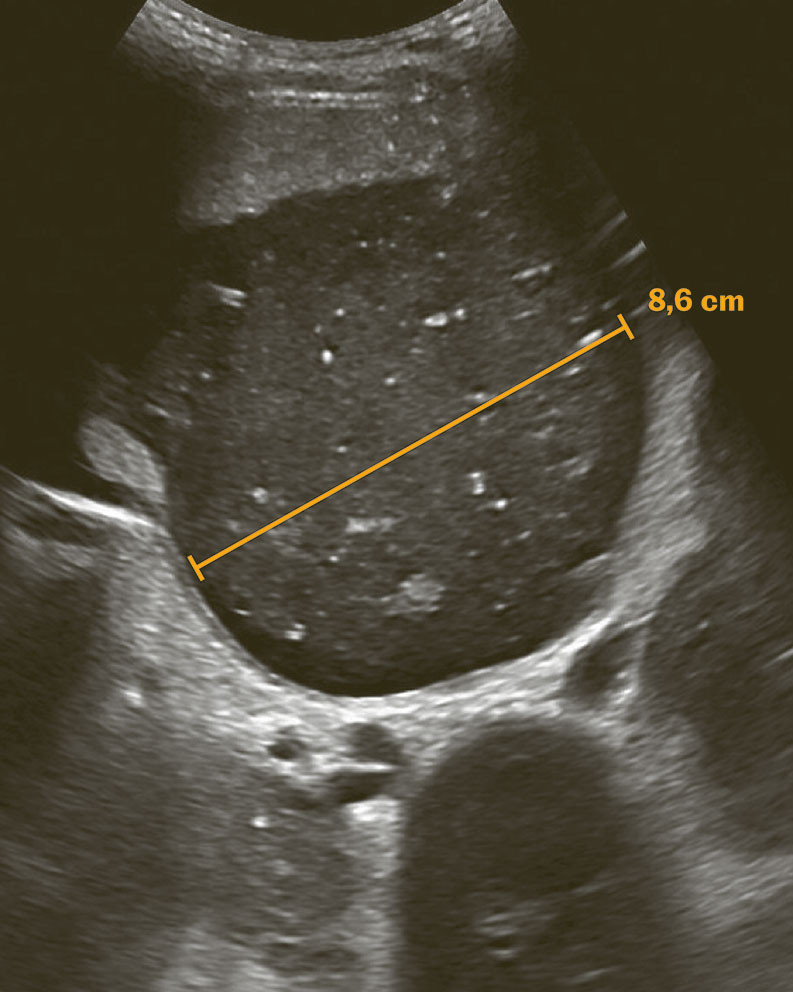 Figur 1 Transabdominal ultralyd viser en cystisk struktur m&aring;lt til 8,6 diameter, som ble tolket som fekalisert innhold i&hellip;