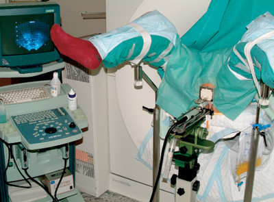 Figure 2 A patient in position for high-dose-rate brachytherapy: An ultrasound probe is placed in the rectum and a&hellip;