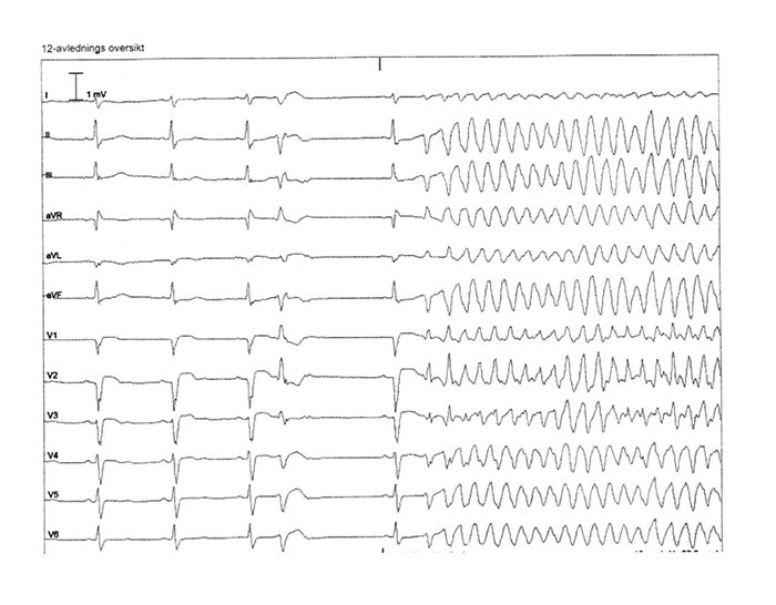 Figure 2  ECG shows two normal beats followed by a ventricular extrasystole with a short coupling interval. After this there&hellip;
