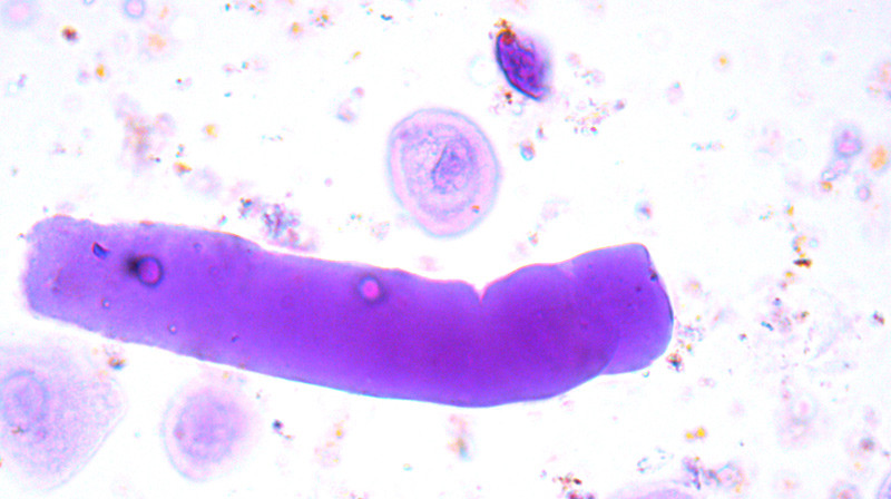 Figure 5  Urine sediment enlarged 40 times shows a waxy cast. These are usually casts of the broad parts of the tubules&hellip;