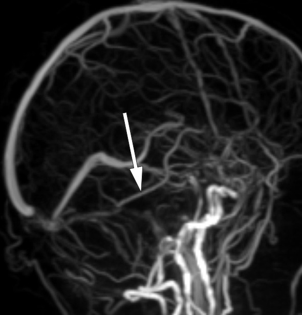 Figure 3  Venous MR angiogram (TOF sequence) shows good filling of the contralateral vein of Labb&eacute; (arrow), but no signal in&hellip;