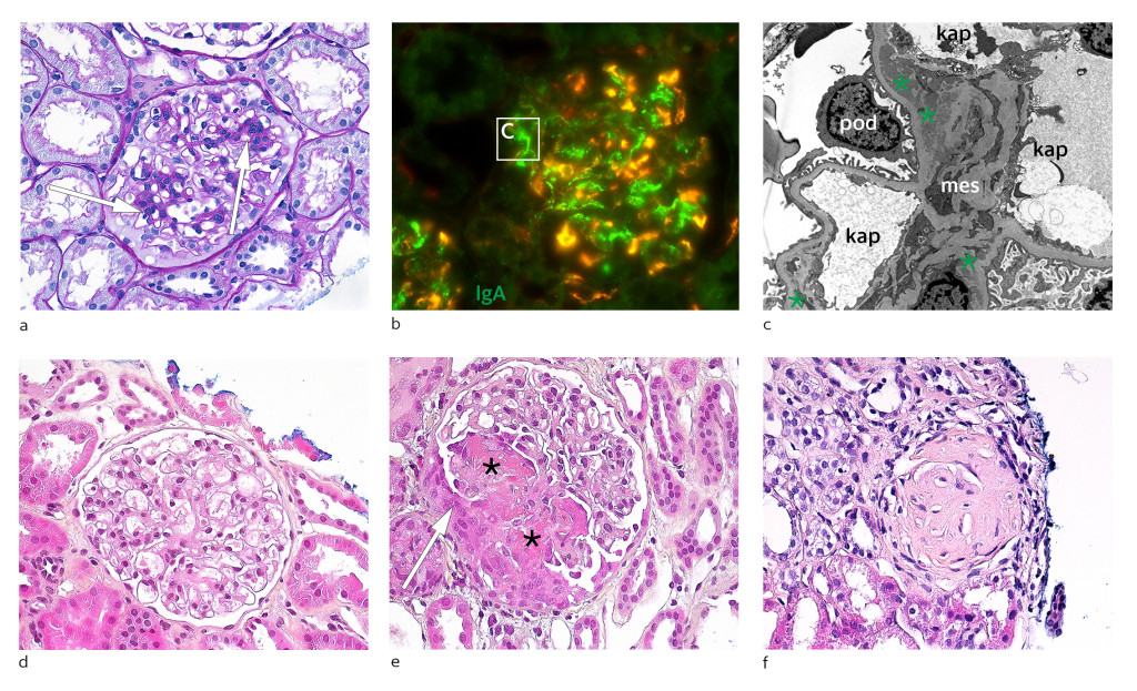 Figure 1 a-c ) IgA vasculitis. d-f) ANCA-associated vasculitis. a) Mesangioproliferative glomerulonephritis with increased&hellip;