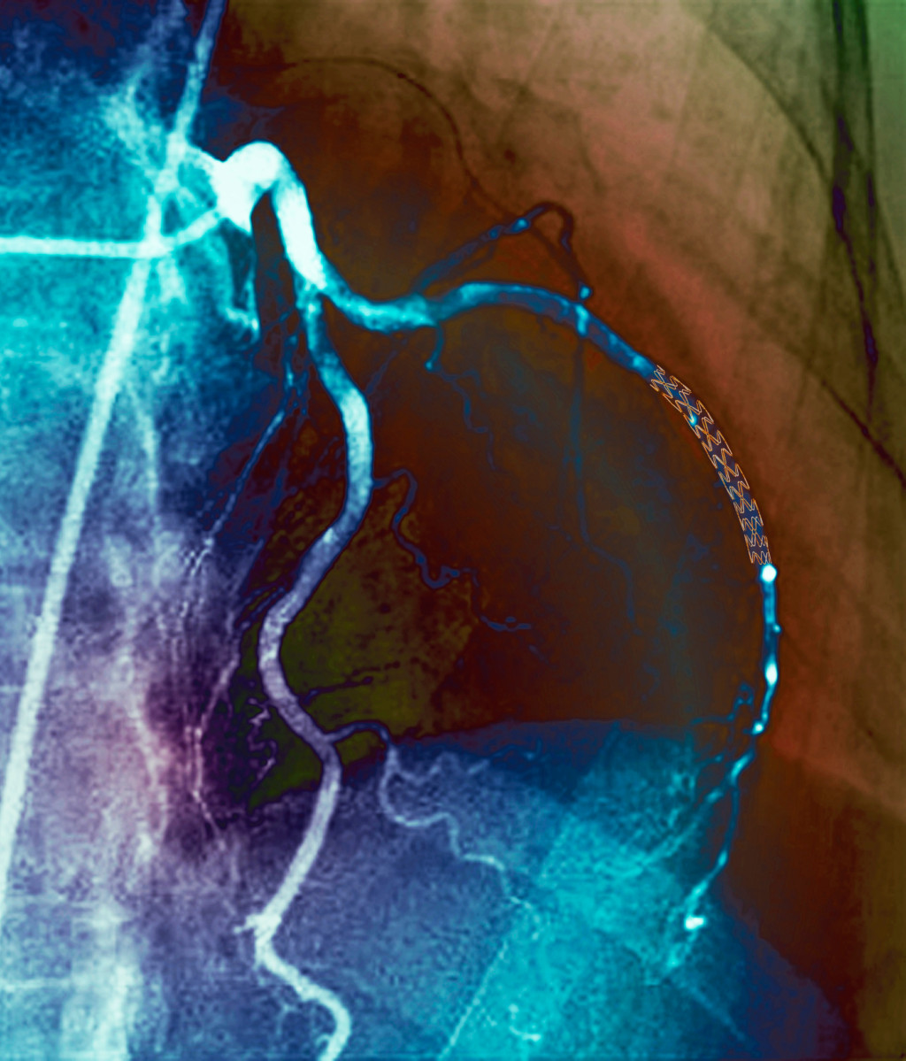 Farget angiogram av koronararteriene hos en 52-&aring;ring, der arterien til h&oslash;yre er stentbehandlet. Foto: Science Photo Library