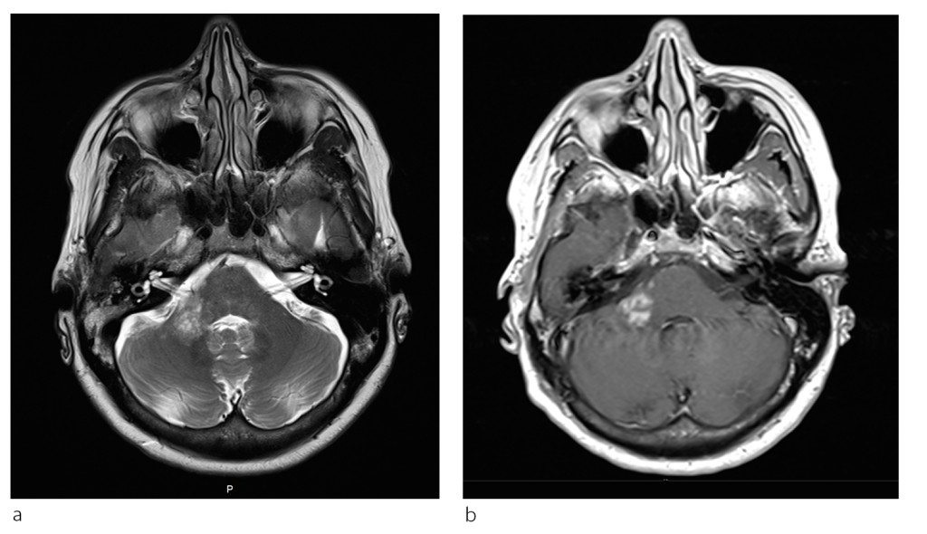 Figure 2 a) The T2-weighted image shows an inhomogeneous hyperintense lesion in the right cerebellar peduncle that cannot&hellip;