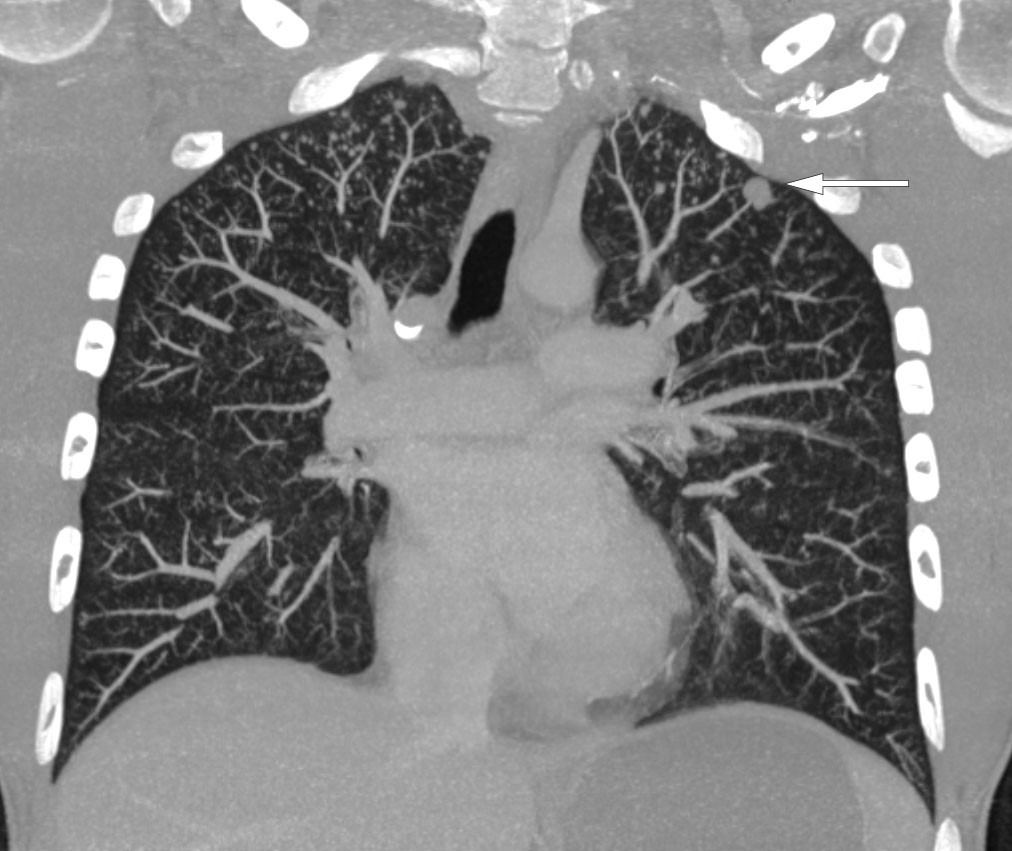 Figure 3 CT thorax taken after injection of intravenous contrast medium. The image shows multiple micronodules in the tops&hellip;