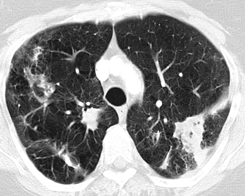 Figure 1 CT thorax of a patient with severe COPD with emphysema. Cavernous and fibrotic changes and infiltrates are seen&hellip;