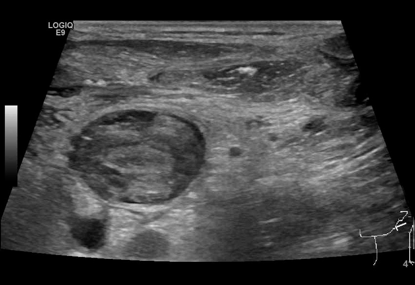 Figure 2 Ultrasound visualisation of thrombotic mass in the left internal jugular vein, cross section.