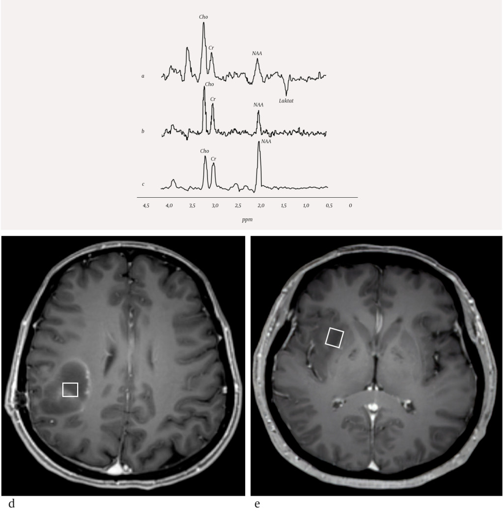 Figure 2 MR spectra of a) high grade glioma, b) low grade glioma and c) a healthy person, and T1-weighted MRI showing volume&hellip;