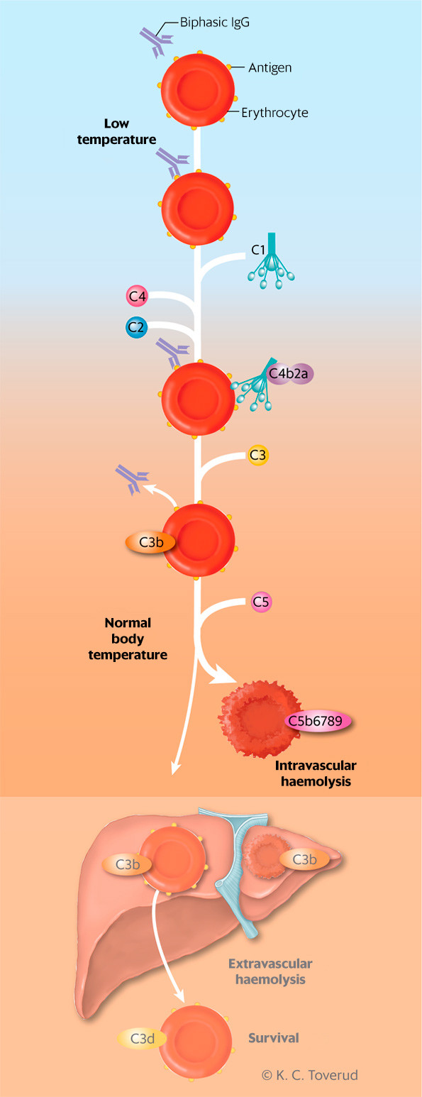 Figure 3 Complement-mediated haemolysis induced by biphasic IgG (Donath-Landsteiner antibody). At sub-normal core body&hellip;