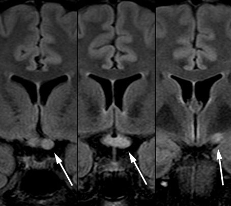 Figure 3 Coronal FLAIR-MRI series with a longitudinally extensive lesion in the left optic nerve, through the optic chiasm&hellip;