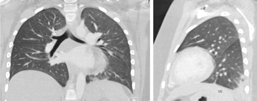 Figure 2 CT thorax with intravenous contrast shows a basilar opacity and modest ground-glass opacities in the left lung, a&hellip;