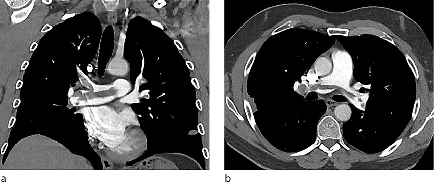 Figure 1 Coronal (a) and axial (b) sections on a CT pulmonary angiogram show widespread emboli in the pulmonary trunk as&hellip;