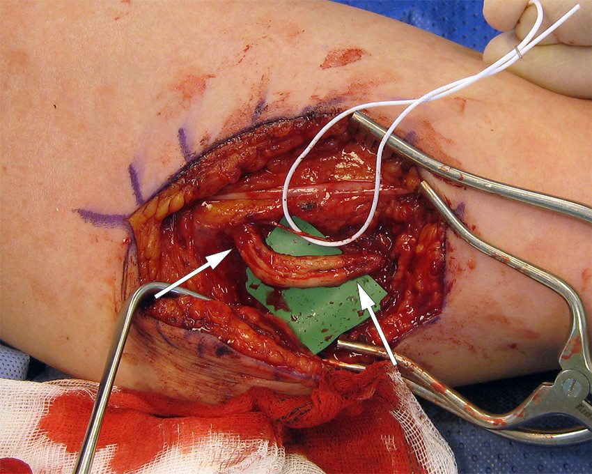 Figure 1 Image from surgery, medial upper arm. A small fascicle of the ulnar nerve was intact (held aside with a white band)&hellip;