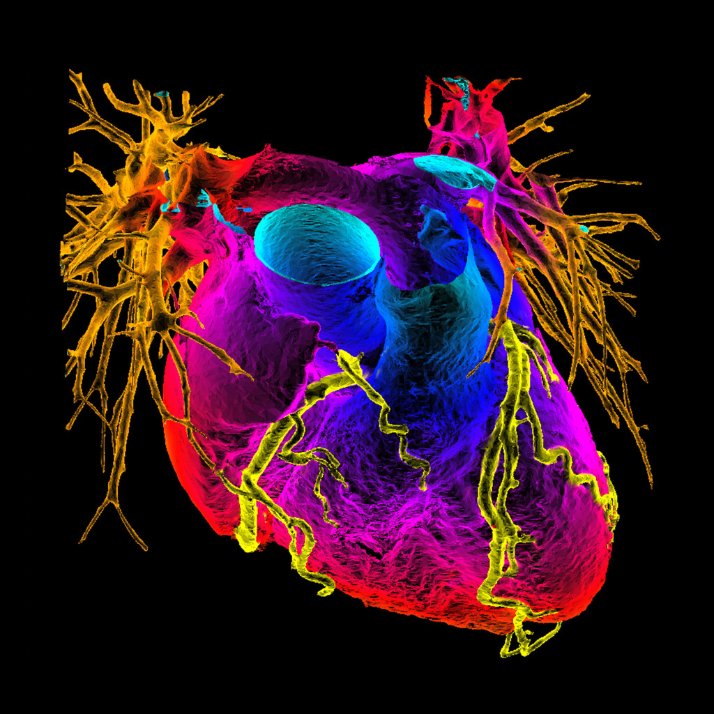 3D-farget CT-angiogram av hjertet. Foto: Science Photo Library / NTB