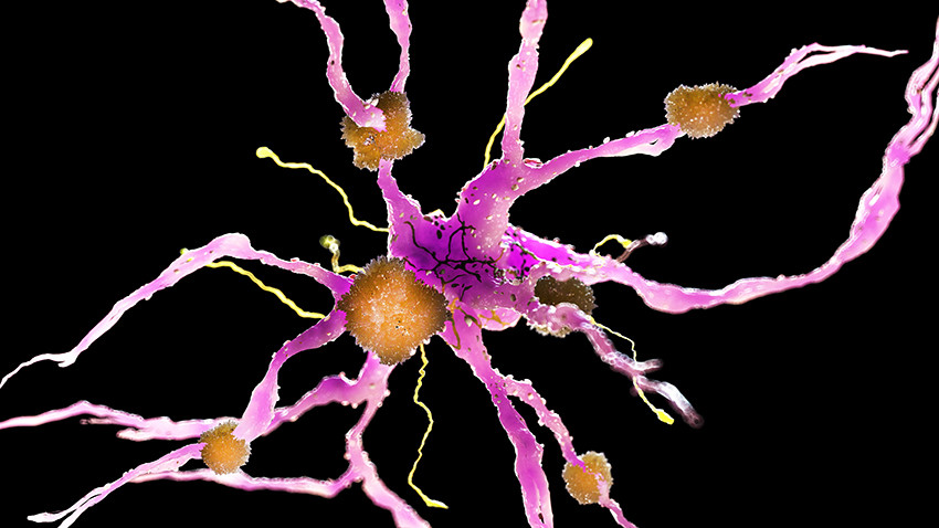 Amyloide avleiringer p&aring; en nervecelle. Illustrasjonsfoto: Science Photo Library / NTB
