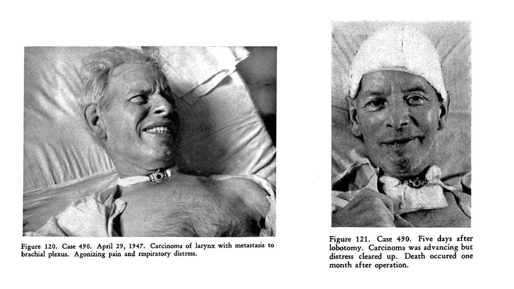 Figure 4 Lobotomy used as a palliative procedure, 'Psychosurgery' by Freeman and Watts, 1950 (2). Facsimile