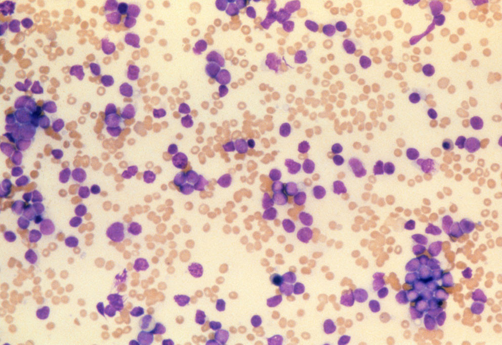 Lysmikrografi av hvite blodceller angrepet av kreft (lilla) ved akutt myelogen leukemi hos mennesker. Illustrasjon: Science&hellip;