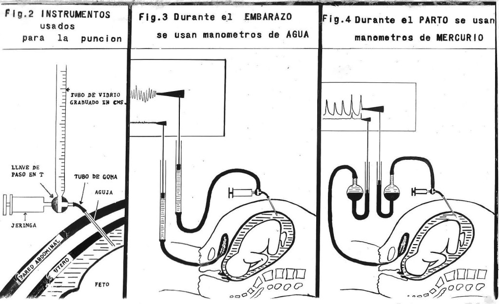 Figure 3 Roberto Caldeyro-Barcias' doctoral work Contractility of the human uterus during pregnancy and childbirth. Photo:&hellip;
